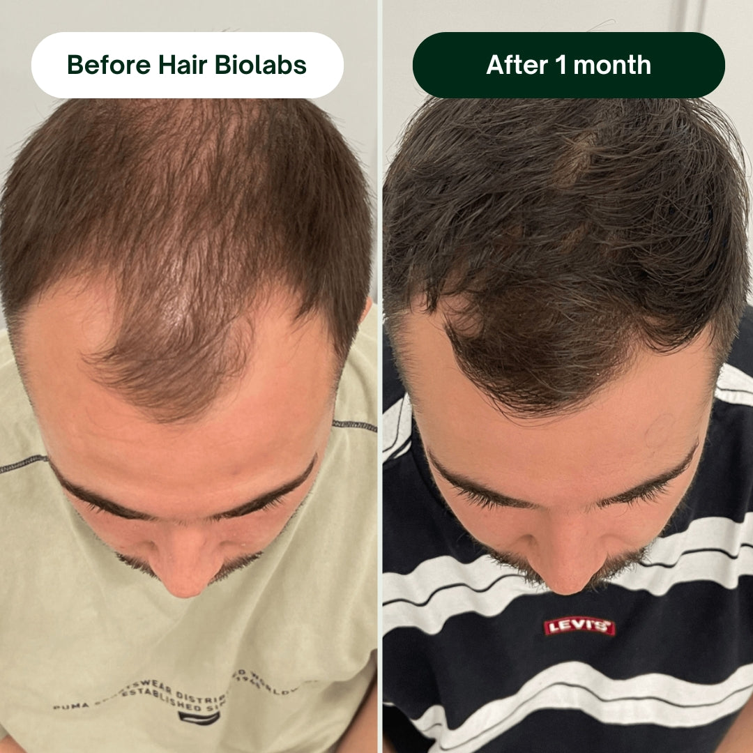 Hair Biolabs™ Hair Regrowth Micro-Infusion System
