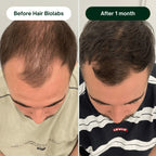 Hair Biolabs™ Hair Regrowth Micro-Infusion System