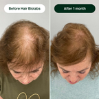 Redensify System™ Hair Regrowth Micro-Infusion Protocol