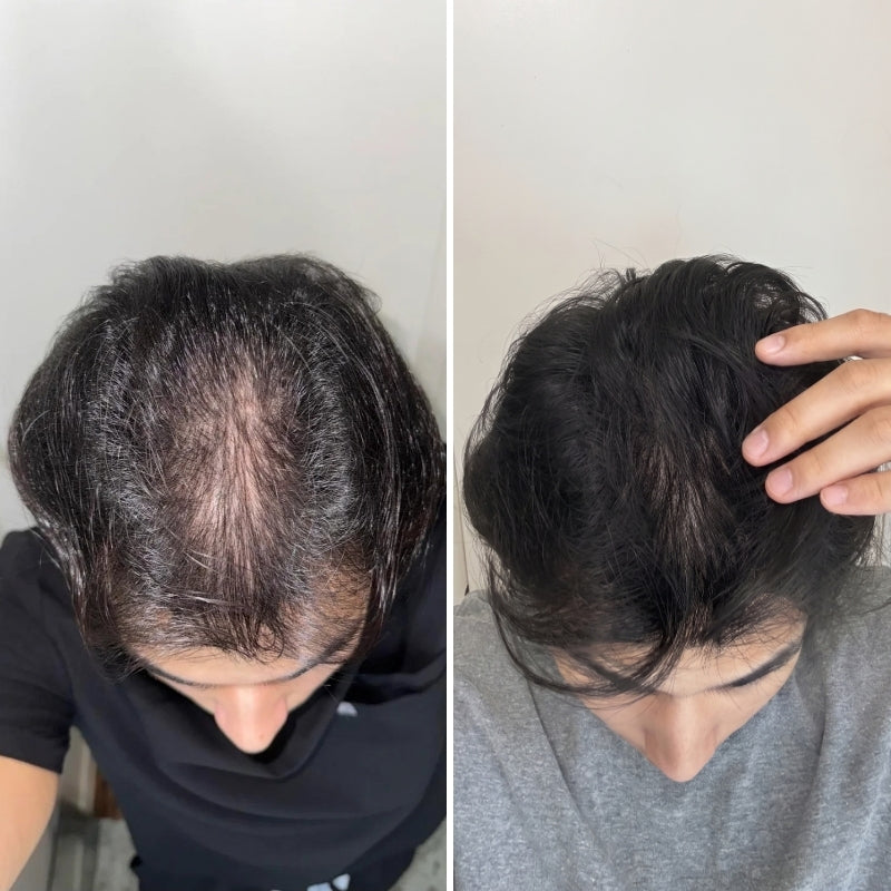 Hair Biolabs® | Sistema de Microinfusión para el crecimiento del cabello