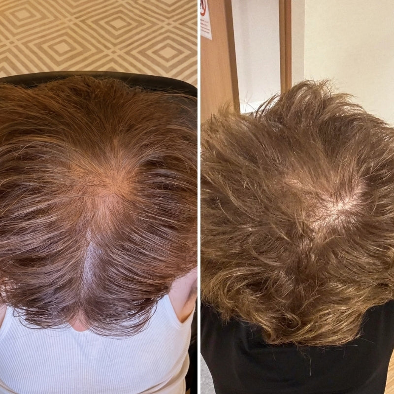 Hair Biolabs® | Sistema de Microinfusión para el crecimiento del cabello