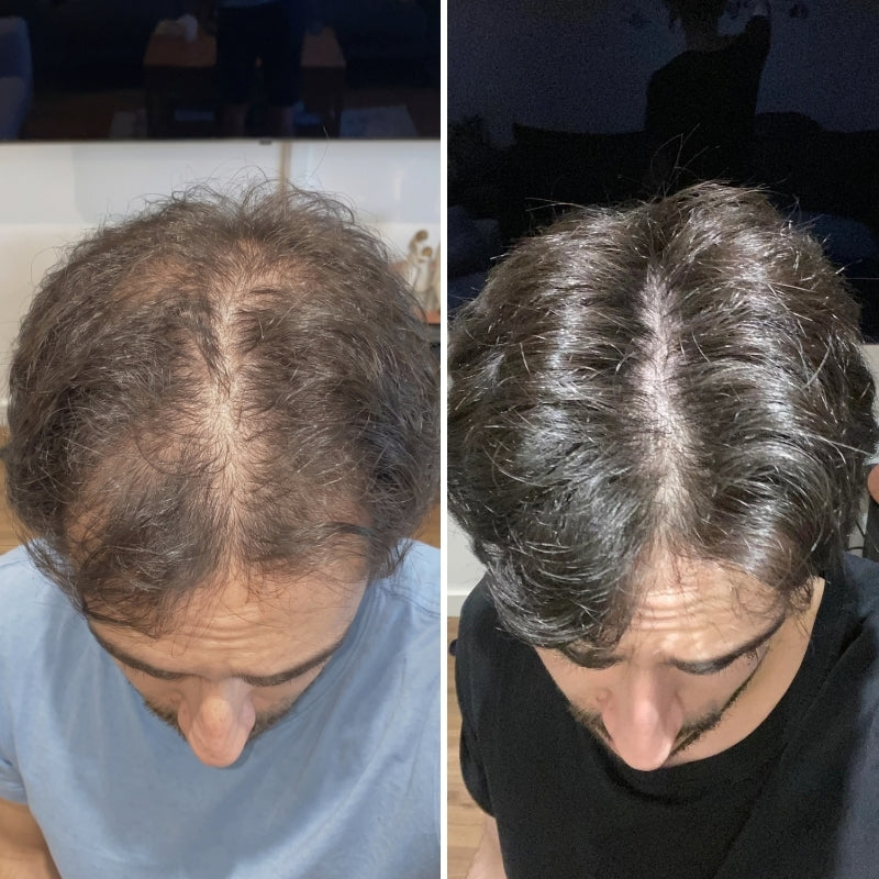 Hair Biolabs® | Sistema de Microinfusión para el crecimiento del cabello