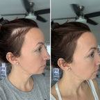 Hair Biolabs | Sistema de Microinfusión para el crecimiento del cabello