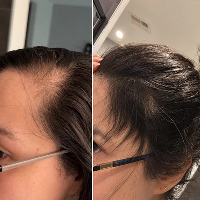 Hair Biolabs | Sistema de Microinfusión para el crecimiento del cabello
