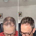 Hair Biolabs® | Sistema de Microinfusión para el crecimiento del cabello
