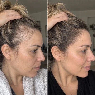 Hair Biolabs | Sistema de Microinfusión para el crecimiento del cabello