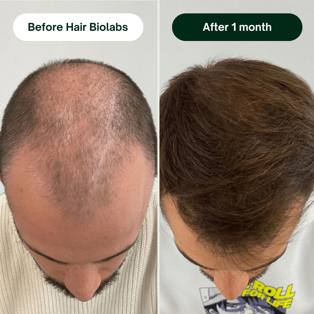 Hair Biolabs™ Hair Regrowth Micro-Infusion System