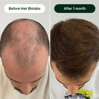 Hair Biolabs™ Hair Regrowth Micro-Infusion System